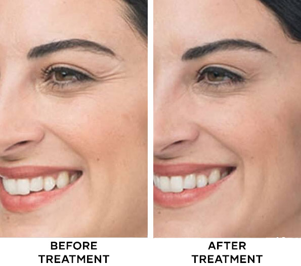 Botox before and after results of Crow's Feet Bali