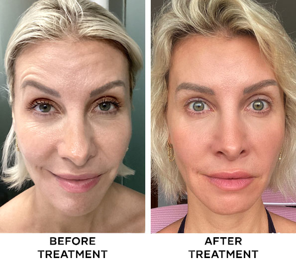 Before and after forehead Botox treatment at Cocoon Medical Spa Bali