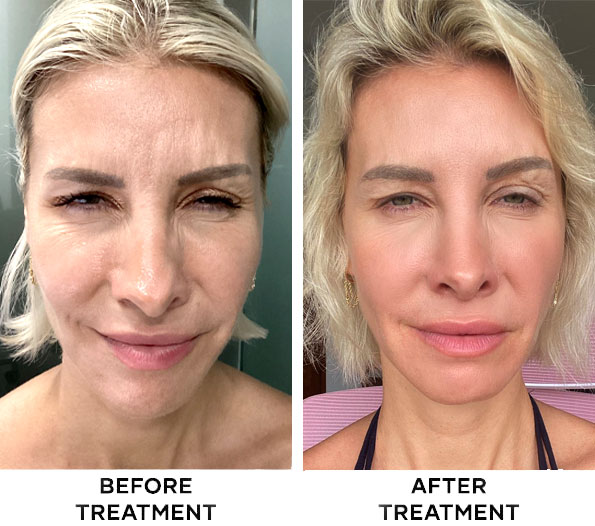 Before and after forehead Botox results in Bali