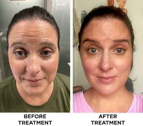 Forehead Botox treatment results at Cocoon Medical Spa