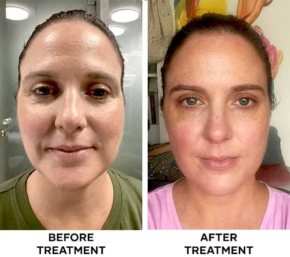Forehead Botox results in Bali