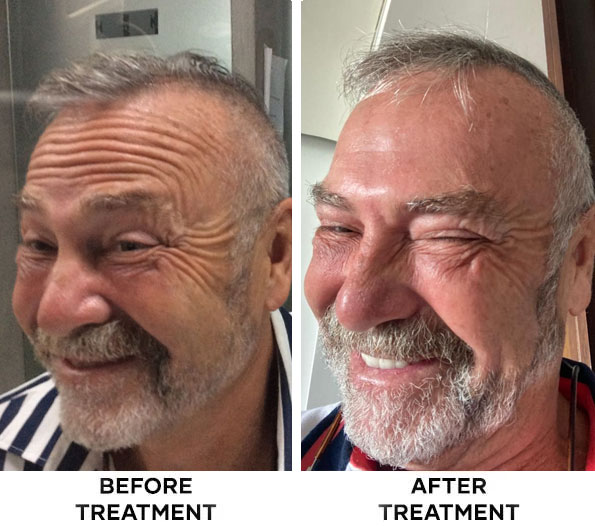 Before and after forehead Botox treatment at Cocoon Medical Spa Bali