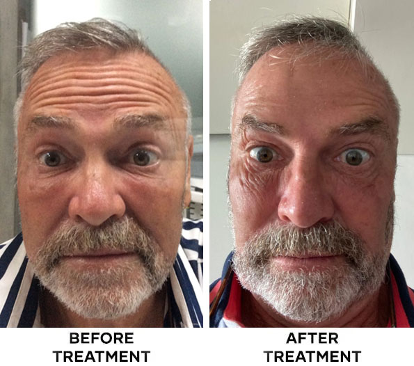 Before and after forehead Botox results in Bali