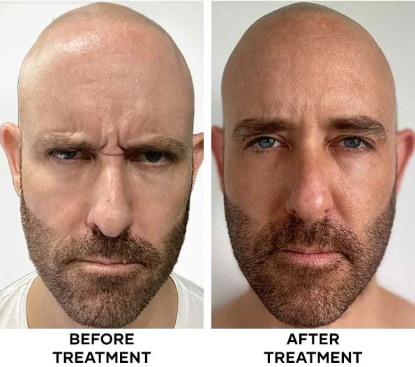 Forehead Botox treatment results at Cocoon Medical Spa