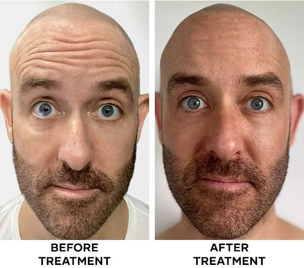 Forehead Botox results in Bali