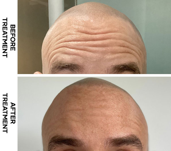 Botox Results Forehead Cocoon Medical Spa