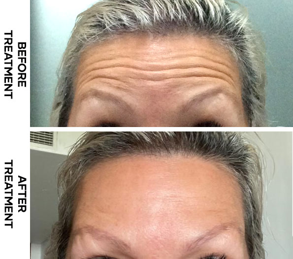 Before and after forehead Botox results in Bali