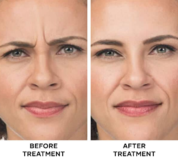 Frownline Botox treatment results at Cocoon Medical Spa