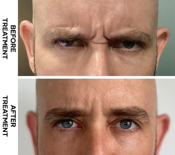 Botox before and after results of Frownline