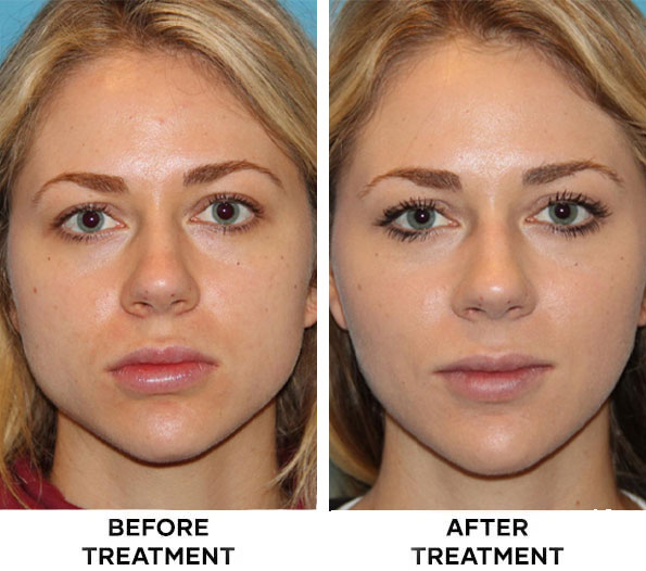 Result Jawline Slimming Botox Result