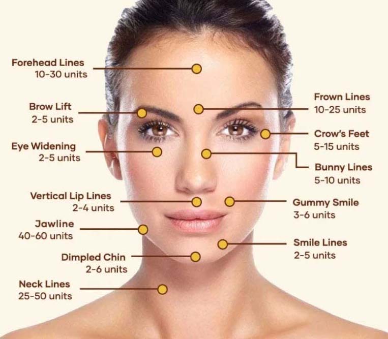 Botox Applications Points