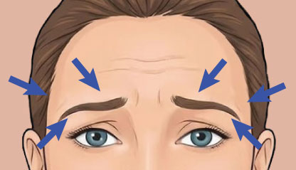 Illustration of Brow Lift