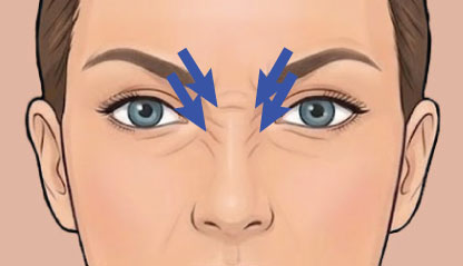Illustration of Bunny Lines