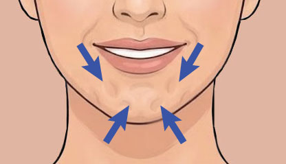 Illustration of Chin Dimpling