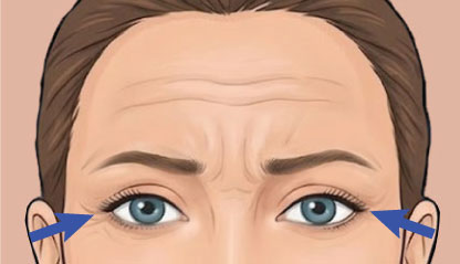 Illustration of Crow's Feet
