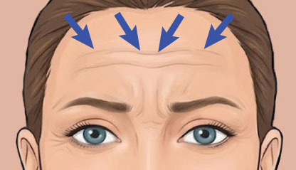 Illustration of forehead lines.