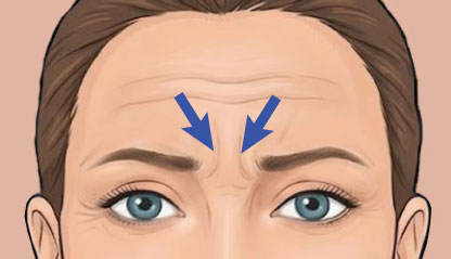 Illustration of forwn lines