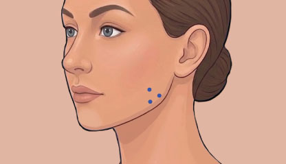 Illustration of Injections points for Bruxism & Teeth Grinding