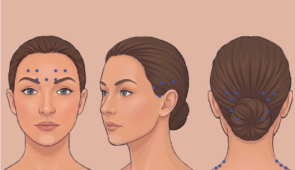 Illustration of Chronic Migraine Relief points