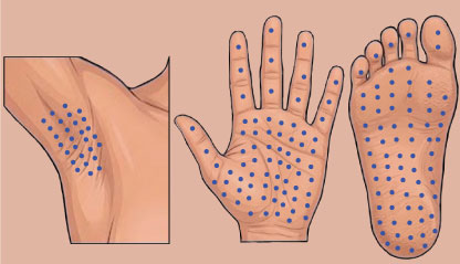 Illustration of Injections points for Hyperhidrosis - Underarms, Palms, Soles.