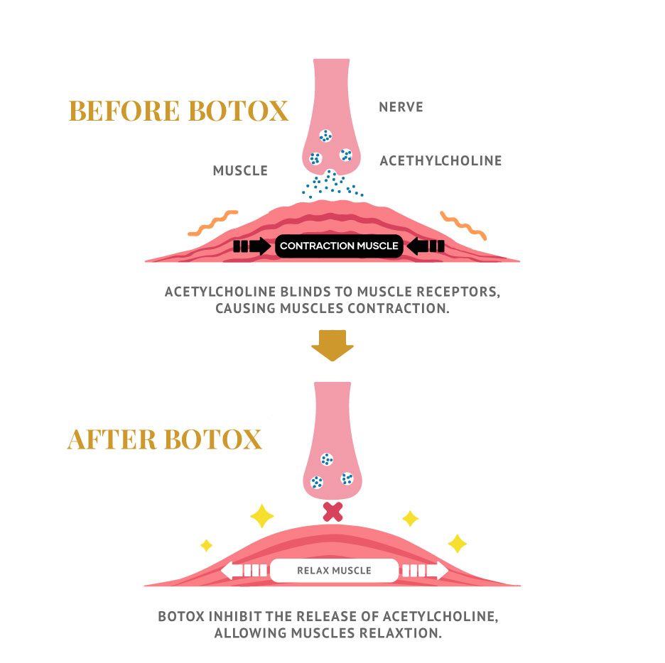 Illustration Before and After Botox muscle relax