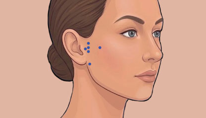 Illustration of Injections points for TMJ Disorders