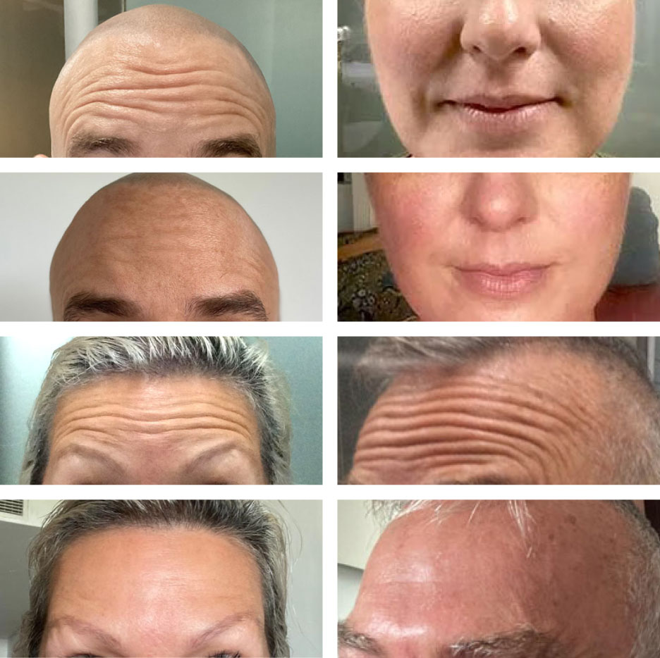 Result Botox - before after images Cocoon Medical Spa